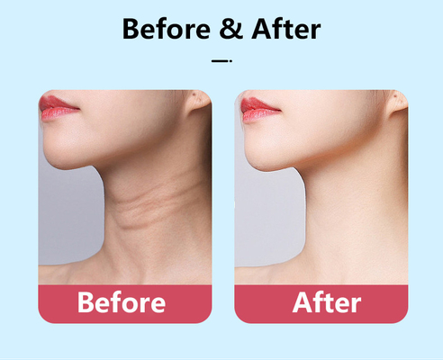Thiết bị loại bỏ nếp nhăn bằng thép không gỉ ABS cho nâng cổ mặt